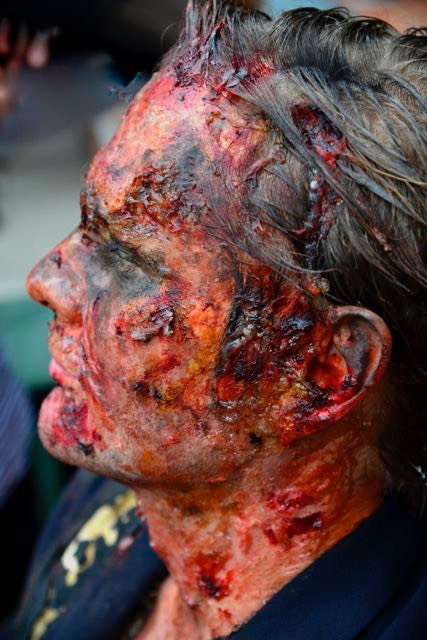 ExplosionsBrandopfer